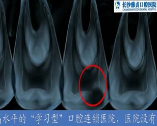 牙髓炎怎么办.mpg